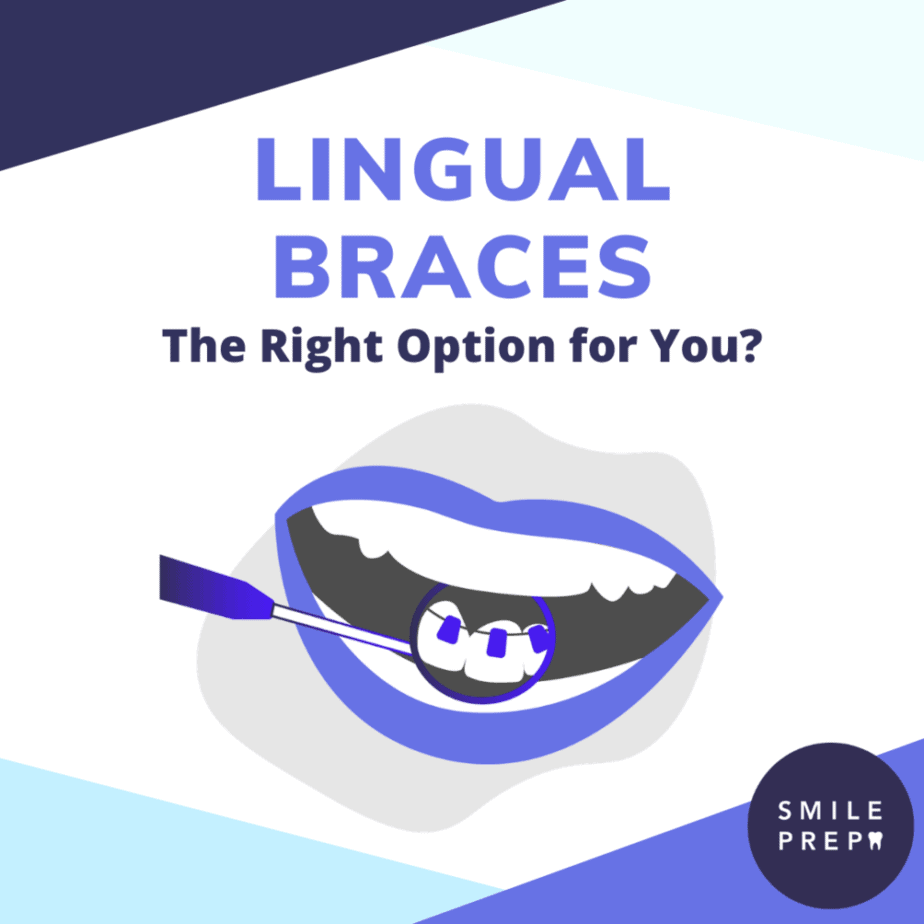 Lingual Braces Guide Image