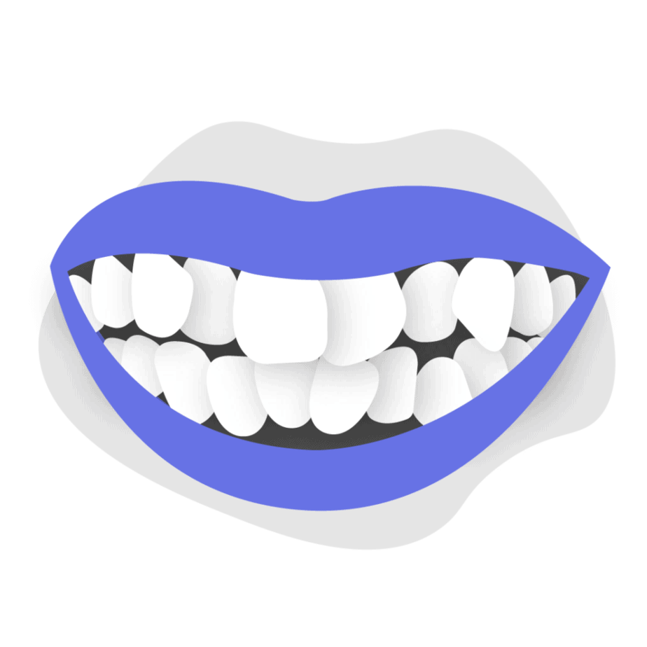 How to treat gaps between teeth in adults