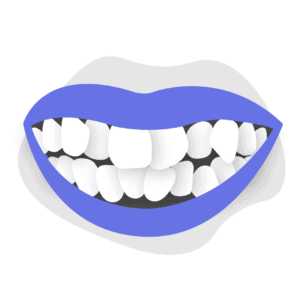 Best Ways to Correct Teeth Crowding in Adults