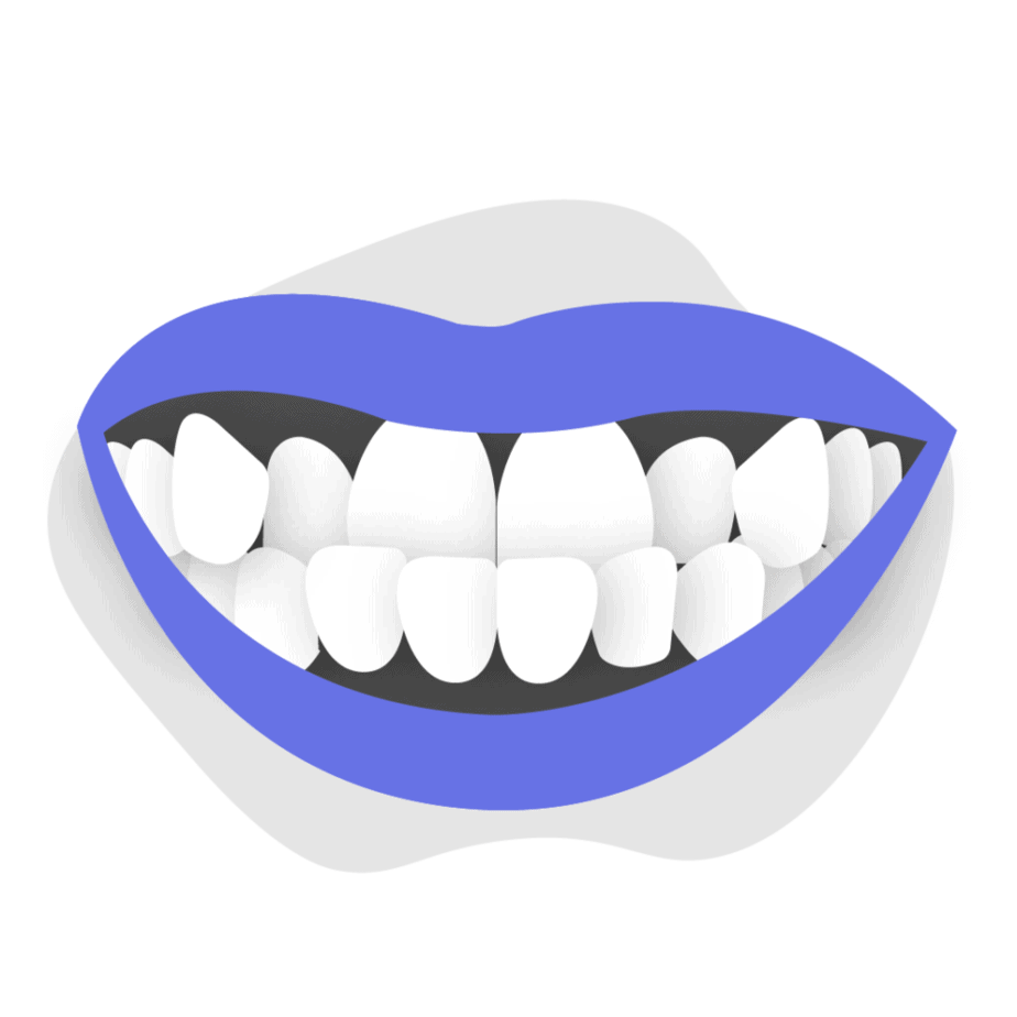 How to treat underbite in adults