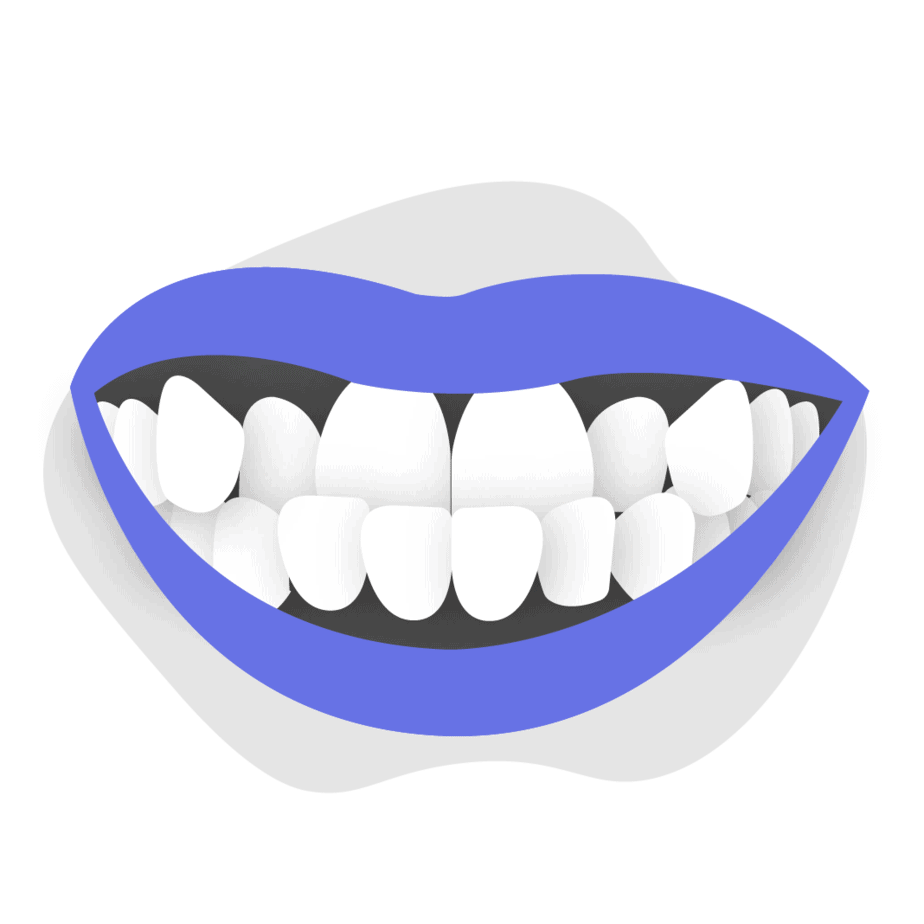 Adult Underbite: What It Is and How To Correct It