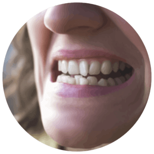 Teeth Crowding Example