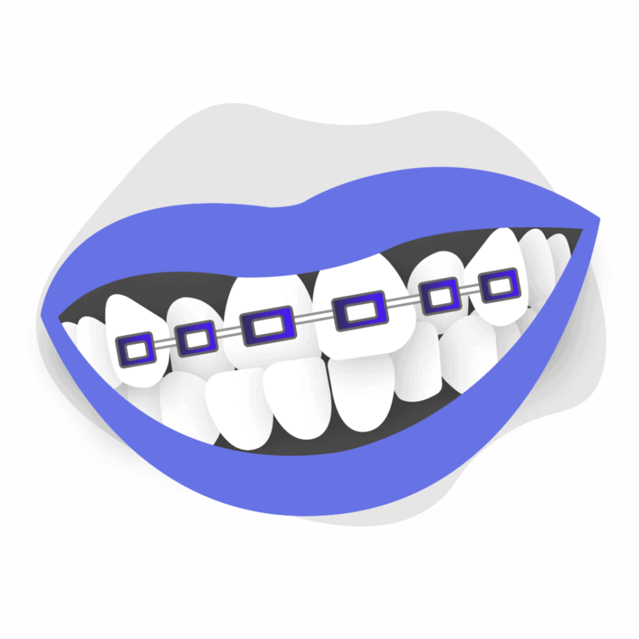 Can braces treat crossbite icon