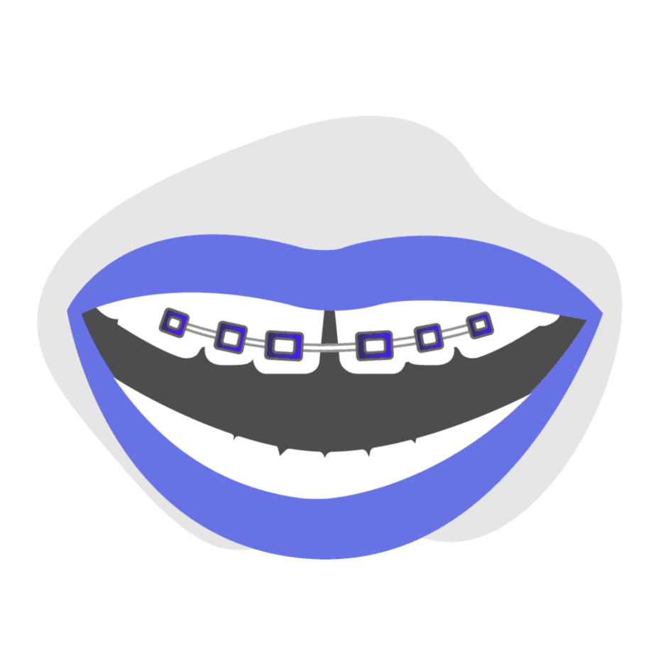 Can braces treat front tooth gap