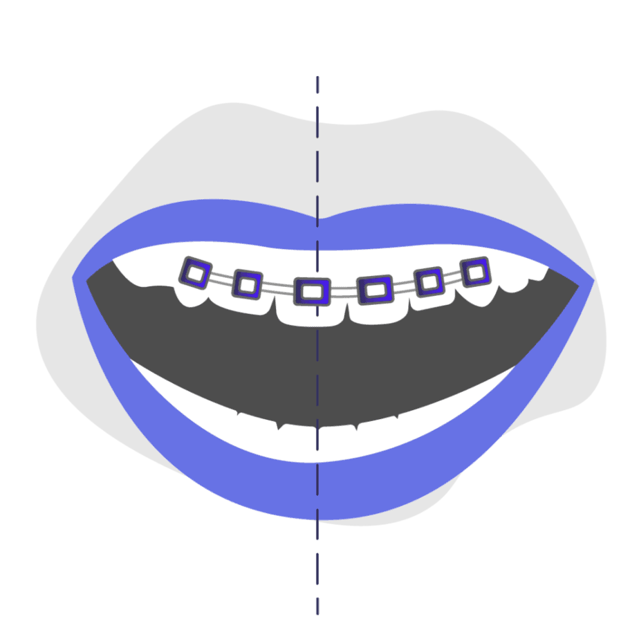 Can braces fix midline misalignment icon