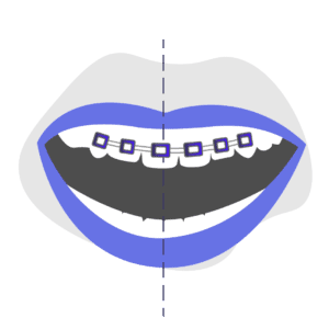 Can Braces Correct Adult Midline Misalignment?