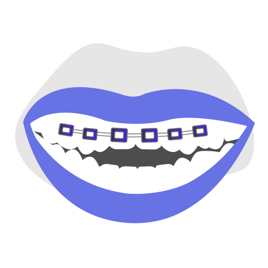 Can braces fix open bite icon