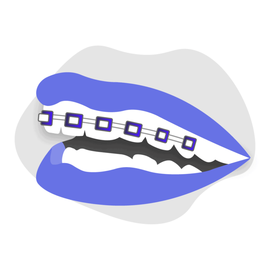 Can braces treat overbite icon