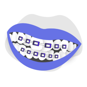 Can Braces Correct Teeth Crowding in Adults?