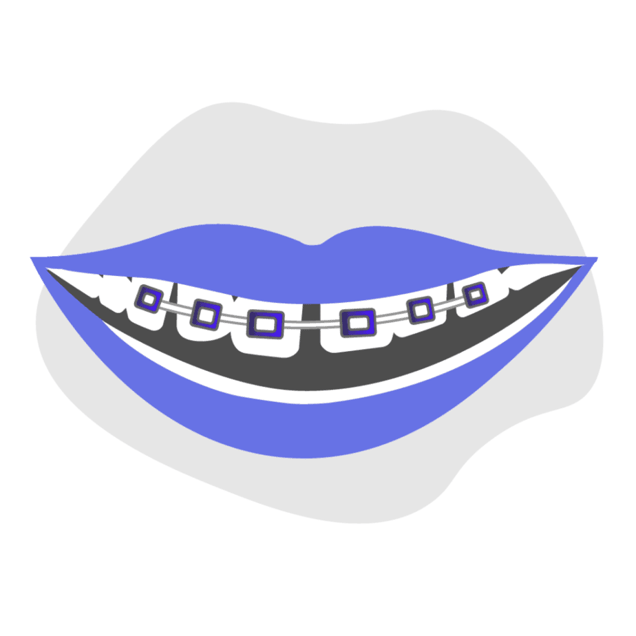 Can braces fix gaps between teeth