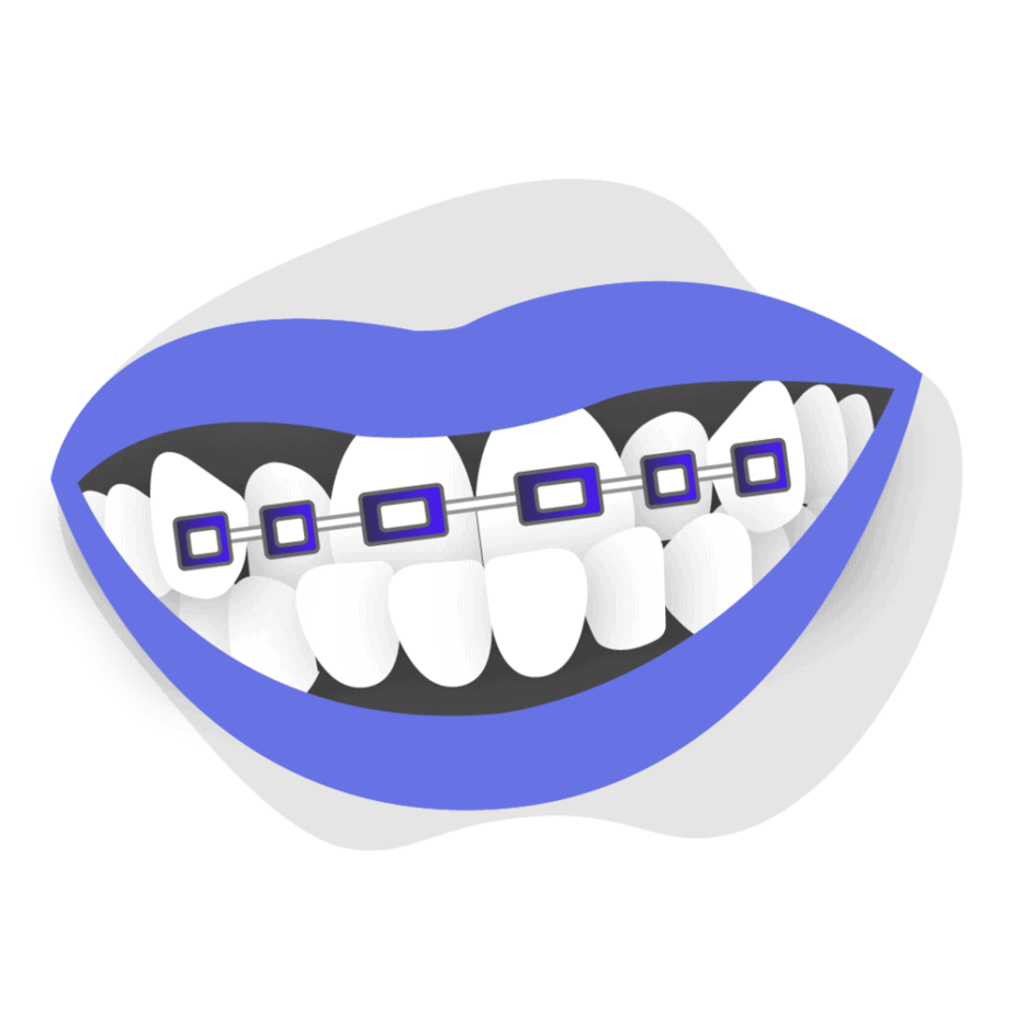 Can braces treat underbite icon