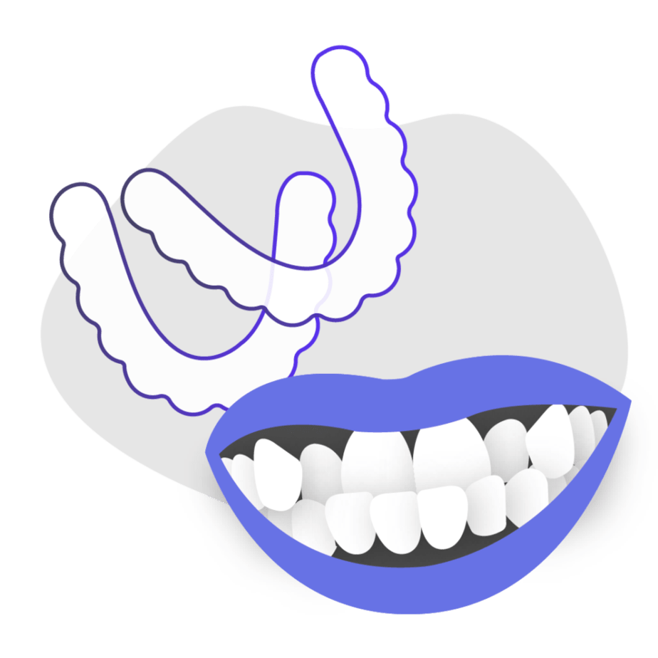 Can At-Home Clear Aligners Treat Underbite