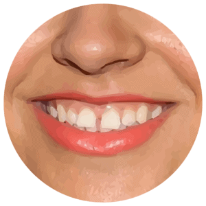 Teeth spacing gaps example