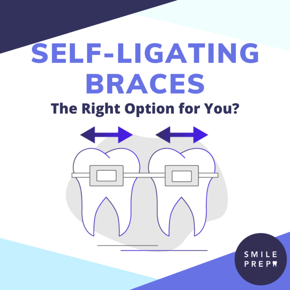 Self-Ligating Braces Guide