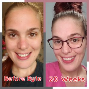 Ashley G Byte Before-After Photos
