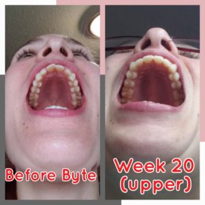 Ashley G Byte Before-After Upper Photos