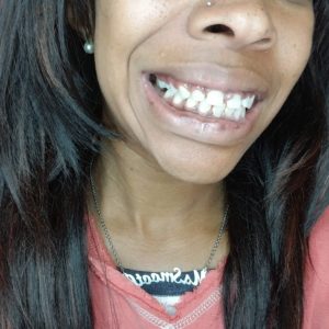 Asia W. Byte Before Photo Teeth Spacing Gap