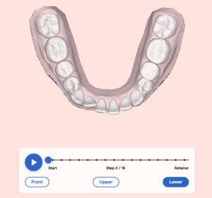 Treatment plan lower arch before aligners