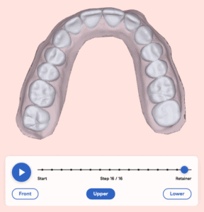 Treatment plan upper arch after aligners