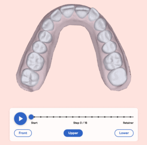 Treatment plan upper arch before aligners