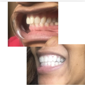 Mia T. Candid Co Aligners Before After Photo Chicago IL