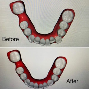 Tena W Byte Before and After Lower Arch