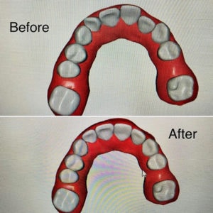 Tena W Byte Before and After Upper Arch