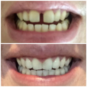 Alicia H SmileDirectClub Before-After Photo