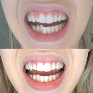 Alicia P SmileDirectClub Before-After Photo