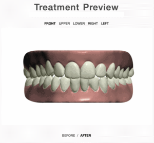Treatment plan front view after aligners