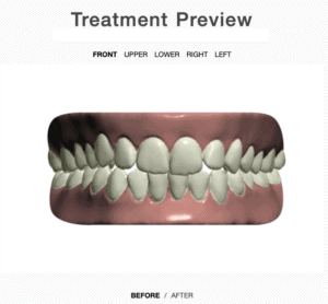 Treatment plan front view before aligners