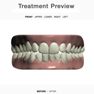 Treatment plan front view before aligners
