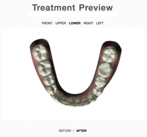 Treatment plan lower arch after aligners