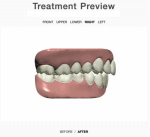 Treatment plan view from the right side after aligners
