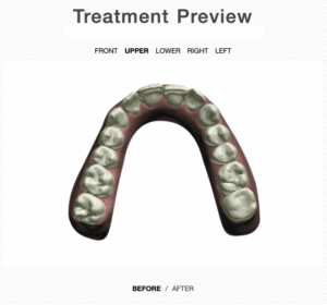 Treatment plan upper arch before aligners