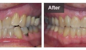 Brian L SmileDirectClub Before-After Photos