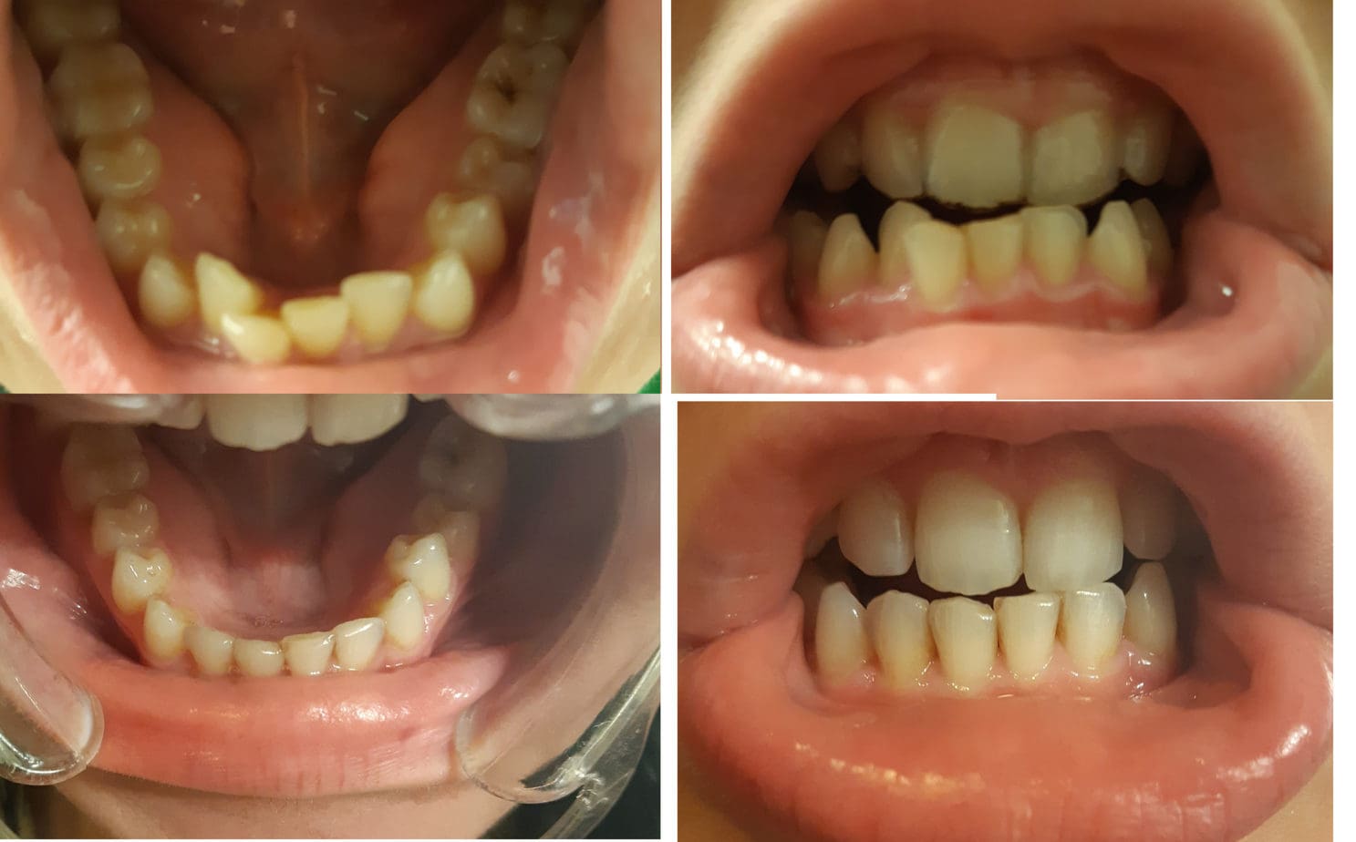 Unknown Facts About Smile Club Direct Before After