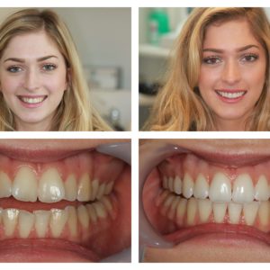 Emily G SmileDirectClub Before-After Photo