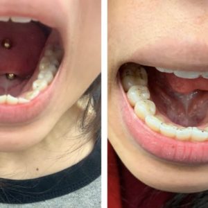 Erica W Invisalign Before-After Photos