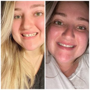 Kalie M SmileDirectClub Before-After Photos