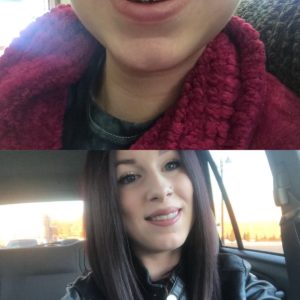 Kari J SmileDirectClub Before-After Photo
