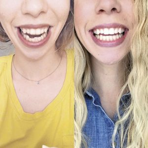 Lindsay K SmileDirectClub Before-After Photos