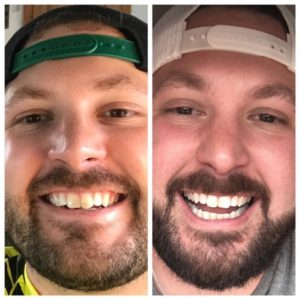 Michael W SmileDirectClub Before-After Photos