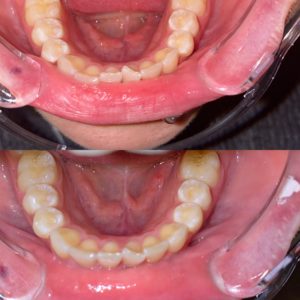 Taylor M SmileDirectClub Before-After Lower Photos
