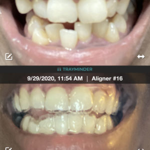 Tiana B SmileDirectClub Before-After Photos