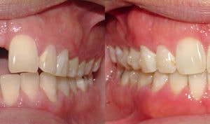 Timmy M Invisalign Before-After Photos