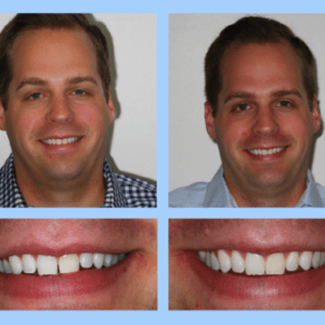 Tyler B Invisalign Before-After Photos