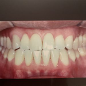 Allan L Invisalign Express Before Front Photo