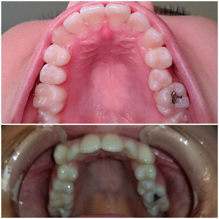 SmileDirectClub Customer Reviews (Before & After Treatment)