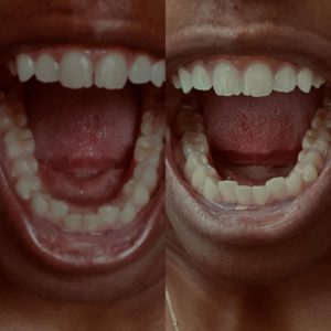 Ashley L Byte Progress Bottom-Teeth Photos
